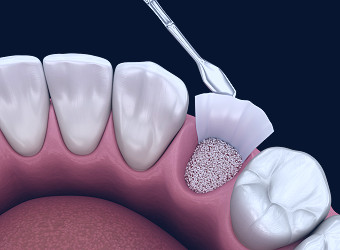 Bone Grafting | Rolla Oral Surgery